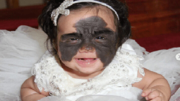 2-ročnému dieťaťu konečne po prelomovej operácii odstránili materské znamienko „Batman“.
