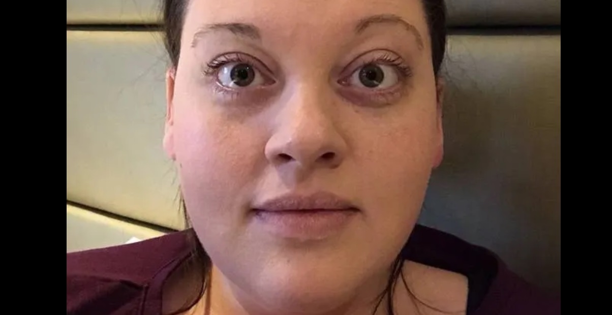 Matka, ktorá prišla kvôli rakovine o polovicu očí, odmieta nosiť umelé oči