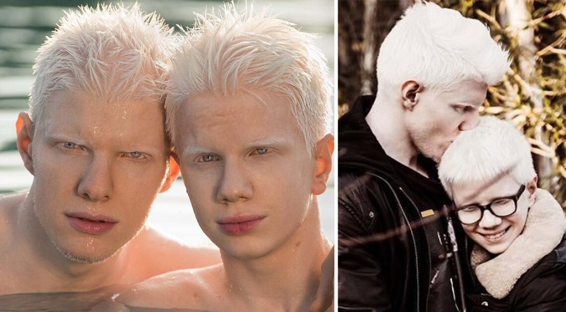 Bera a Tsotne Ivanishviliovci sa narodili s albinizmom: Internet teraz šalie nad ich úžasným vzhľadom!