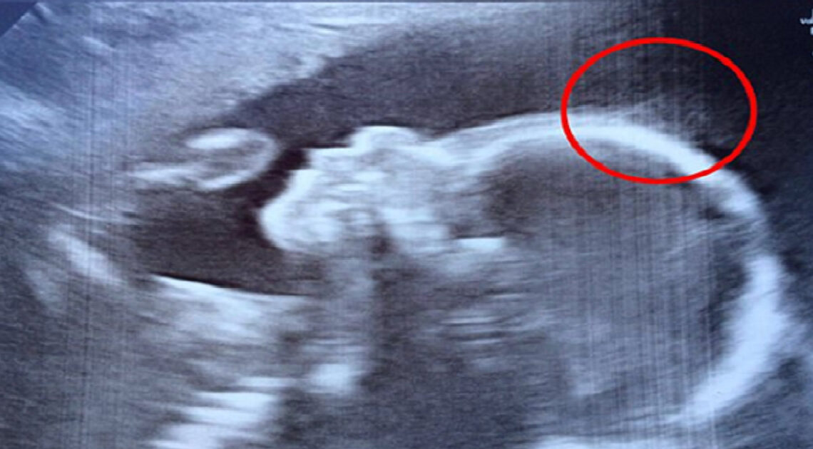 Vlasy dieťaťa boli jasné už na ultrazvuku. Keď sa narodila, lekár takmer odpadol!