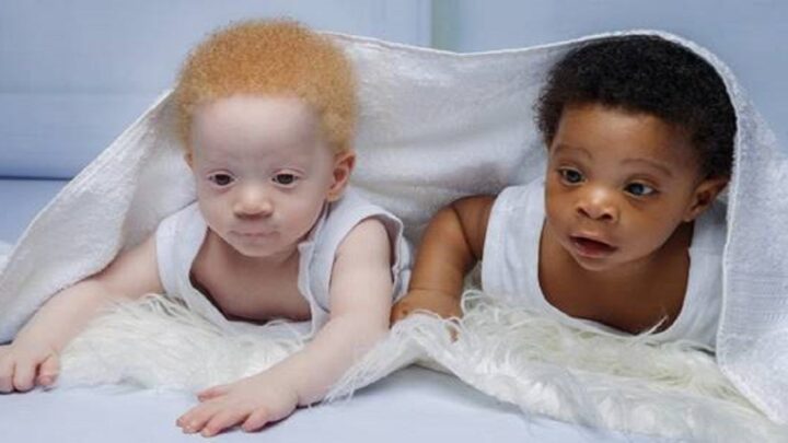 Nigérijskému páru sa narodili veľmi odlišné dvojčatá. Keď otec zistil dôvod, takmer ochorel.