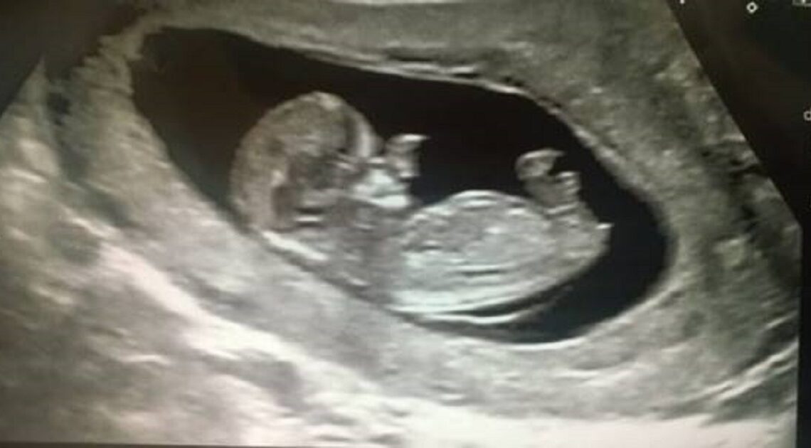 Ultrazvuk ukázal, že z hlavičky dieťaťa niečo trčí. Keď sa dieťa narodilo, všetci boli šokovaní!
