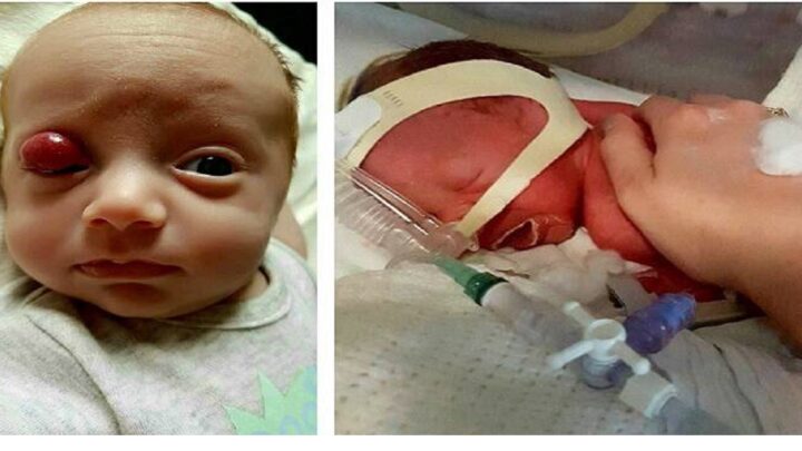 Ich predčasne narodené dieťa sa narodilo s veľkým nádorom na očnom viečku. Keď ich lekári sklamali, nestratili vieru a dokázali nemožné!