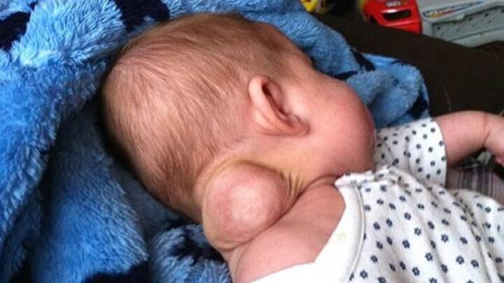 Dieťa sa narodilo so zvláštnym nádorom na krku, ktorý sa zmenil desivým spôsobom…