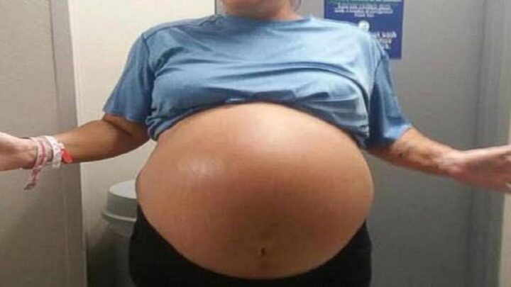 Po pôrode jej brucho rástlo a rástlo. Keď lekári počas operácie uvideli príčinu, okamžite sa chopili fotoaparátu!