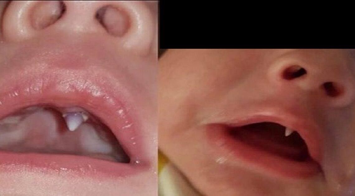 Jedenásťtýždňovému bábätku vyrástol „upírsky zub“. Lekári neverili vlastným očiam!