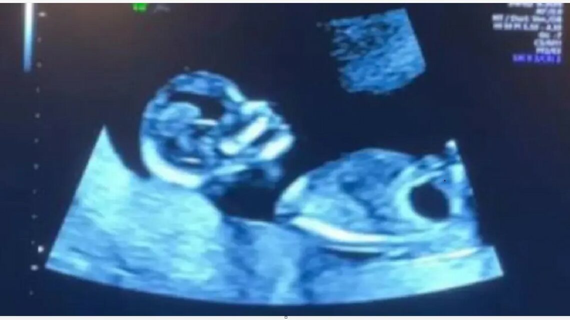V 12. týždni tehotenstva sa na ultrazvukovom vyšetrení objavila čierna škvrna. Lekár sa ani neodvážil určiť diagnózu…